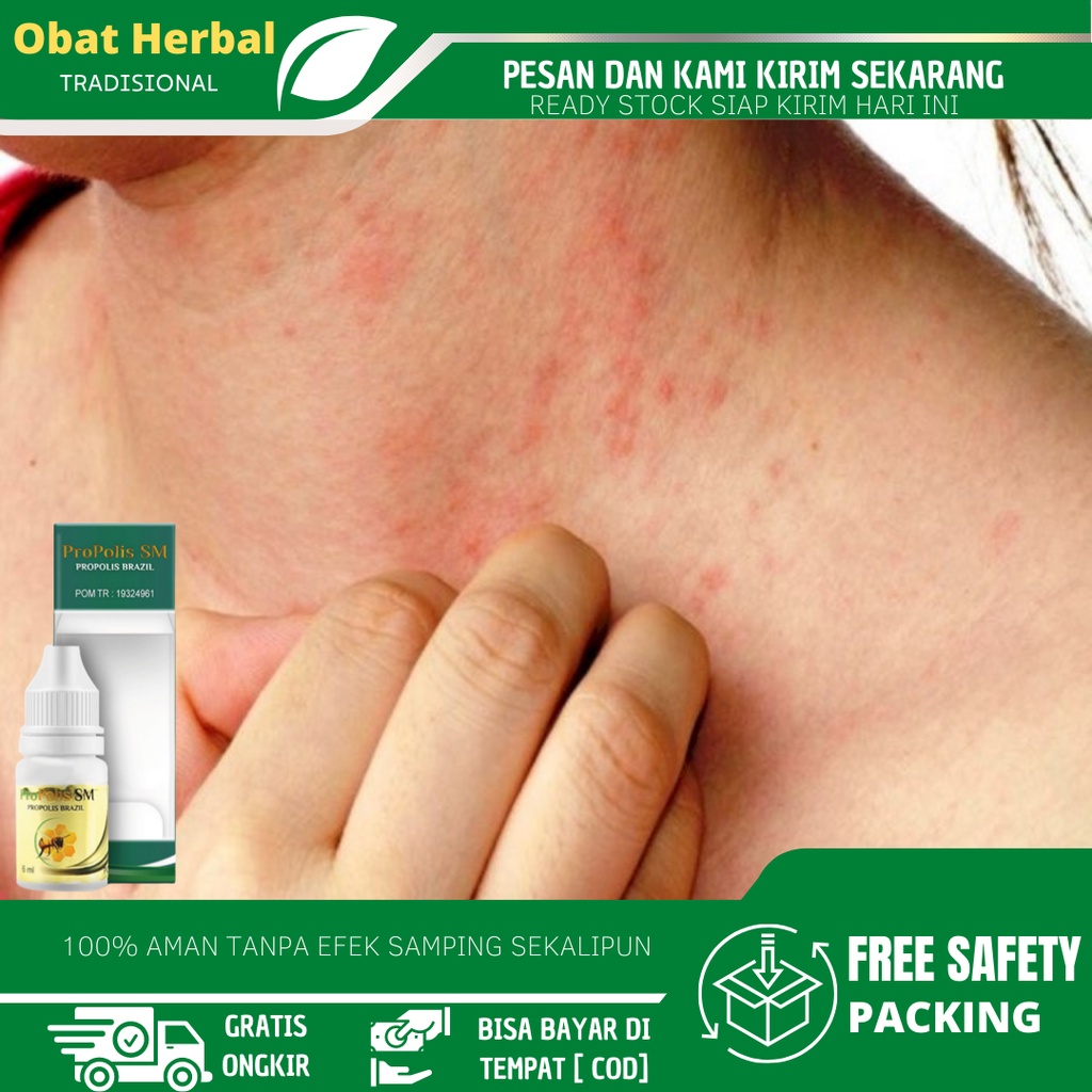 Jual Obat Biang Keringat, Obat Bruntusan Gatal, Ruam Merah Pada Bayi