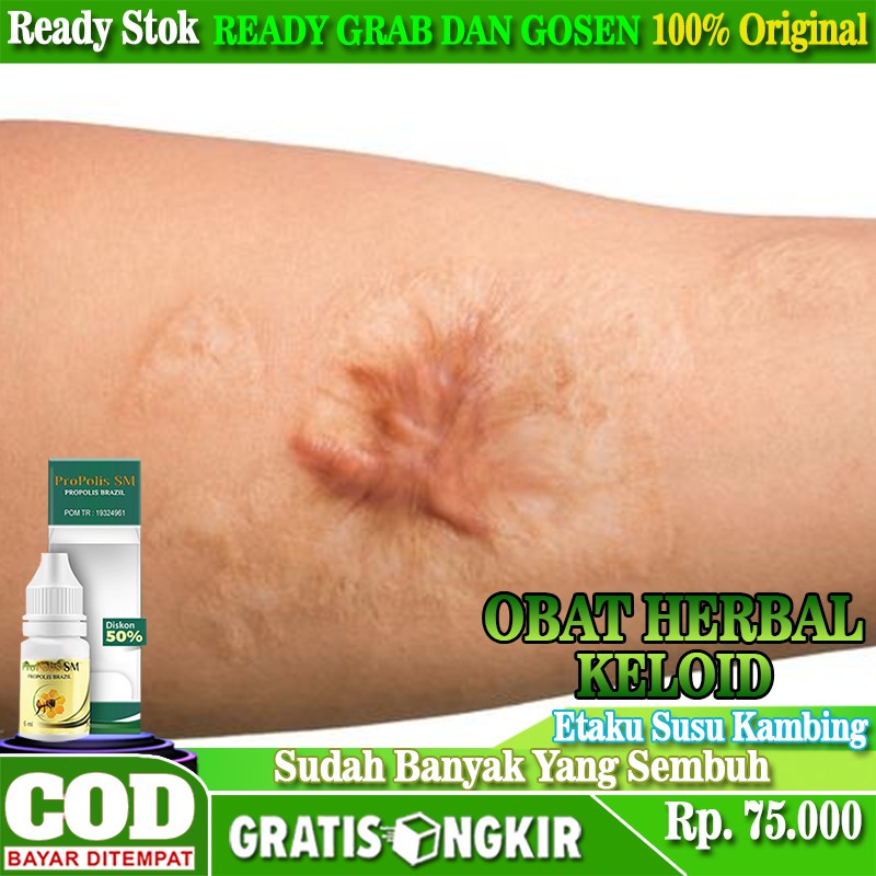 Jual Obat Keloid Penghilang Keloid Keloid Menahun Skin Tag Pengempis Keloid Obat Herbal 1676