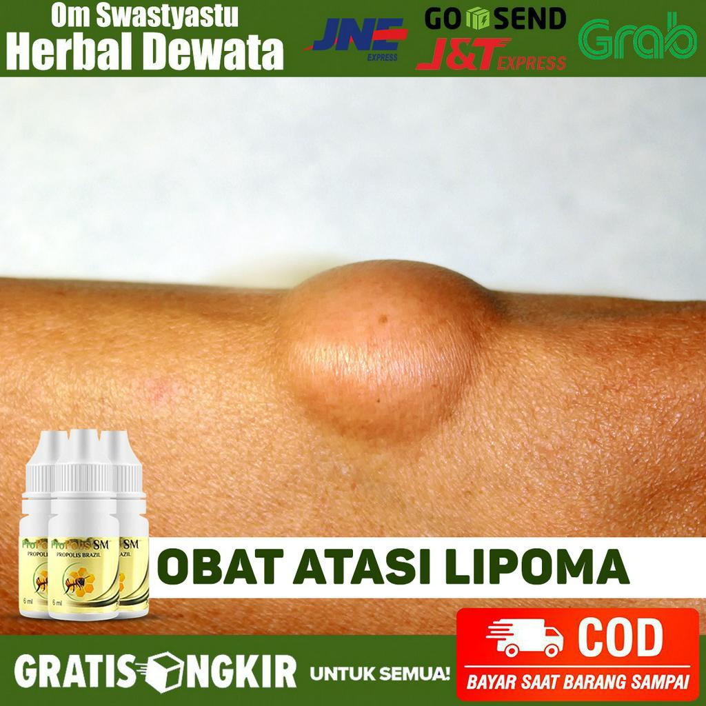 Jual Obat Benjolan Lipoma Benjolan Lemak Benjolan Abnormal Kista