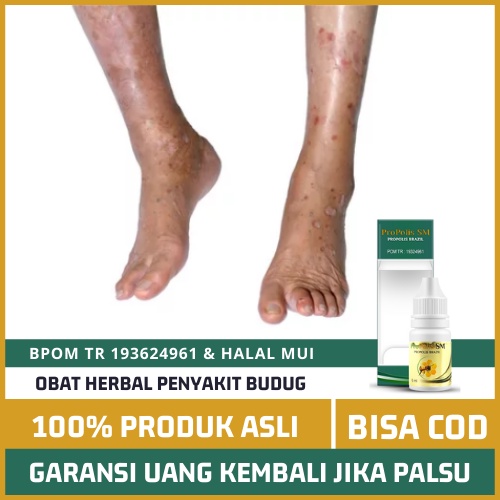 Jual Obat Budug Rasa Kulit Gatal Akibat Tungau Sarcoptes Scabei Di Kaki