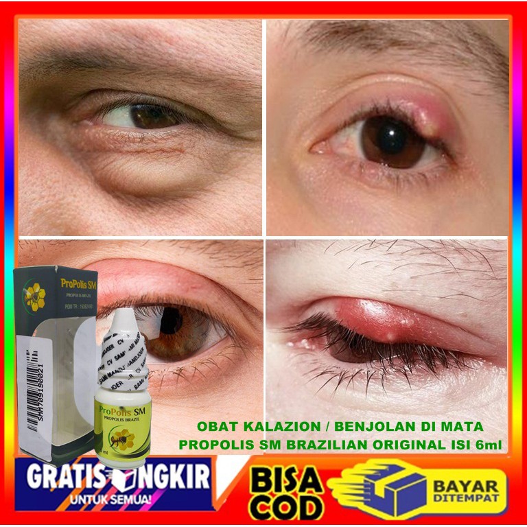 Jual Obat Mata Kalazion, Benjolan Di Kelopak Mata, Mata Bengkak ...