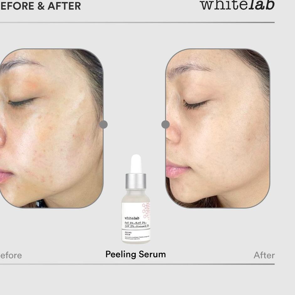 Jual Produk Gk Zq Whitelab Peeling Aha Bha Pha Serum Serum Eksfoliasi Pengangkat Sel Kulit