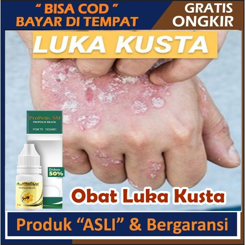 Jual Obat Luka Kusta, Kusta Kering, Kusta Basah, Lepra, Penghilang ...