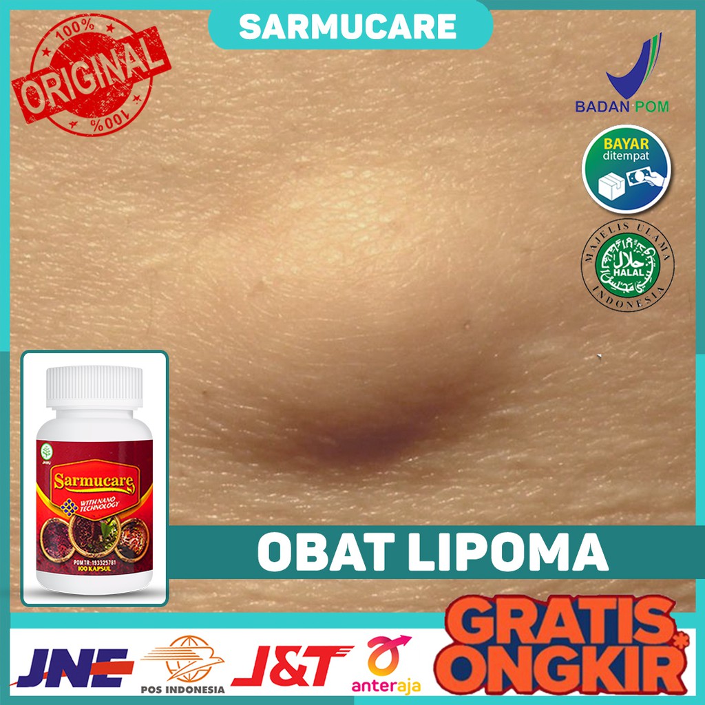 Jual Obat Lipoma Obat Benjolan Benjolan Di Leher Benjolan Di Payudara Benjolan Di