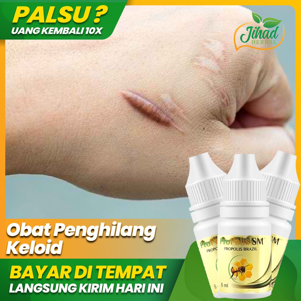 Jual Obat Penghilang Keloid Menghilangkan Bekas Luka Daging Tumbuh