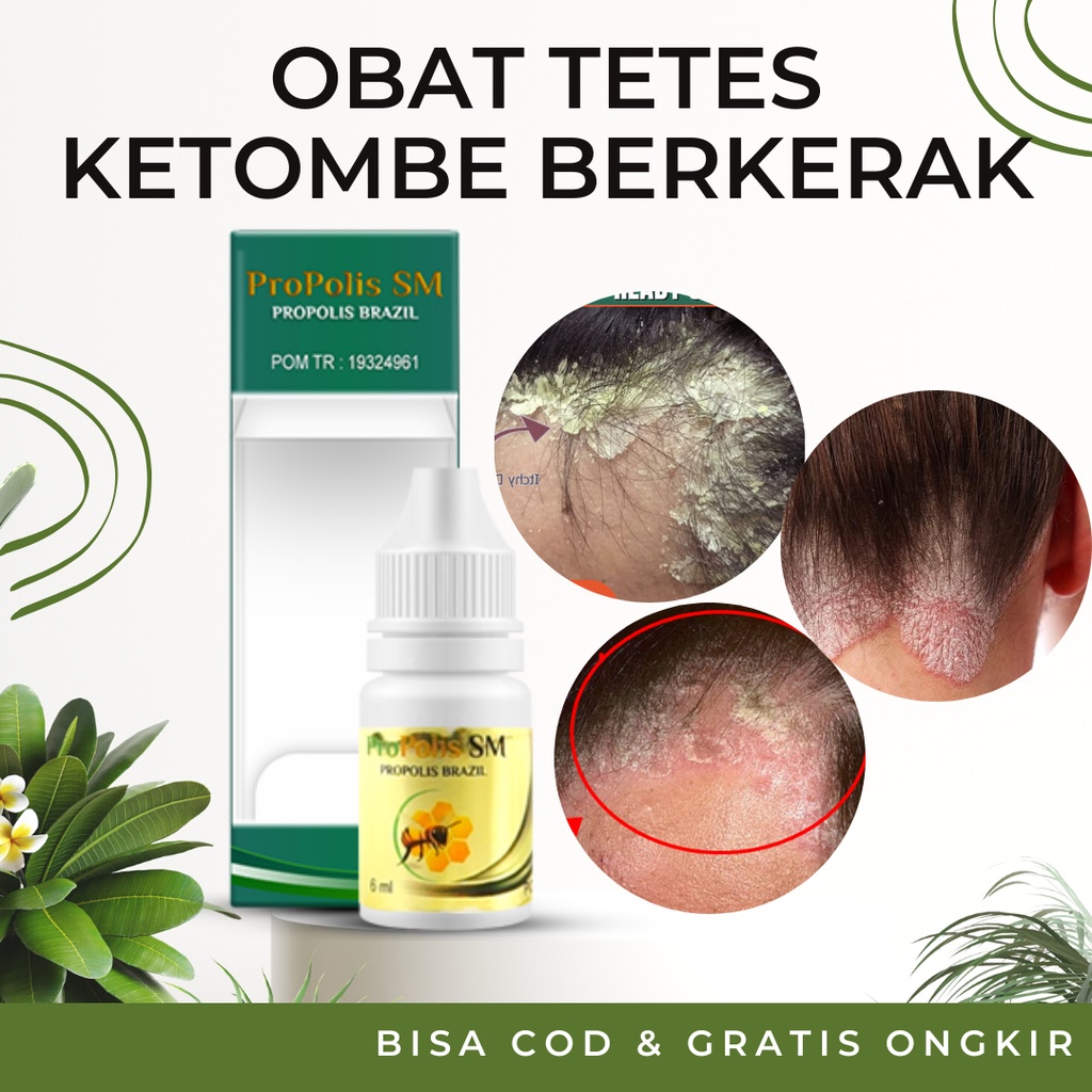 Jual Obat Tetes Ketombe Berkerak Parah Berkerak Salep Borok Kulit Kepala Anti Ketombe Psoriasis 4050