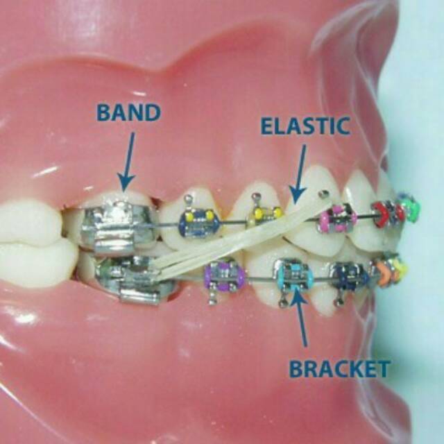 Jual Elastic Orthodontic Rubber Band, Karet Elastis untuk mengaitkan