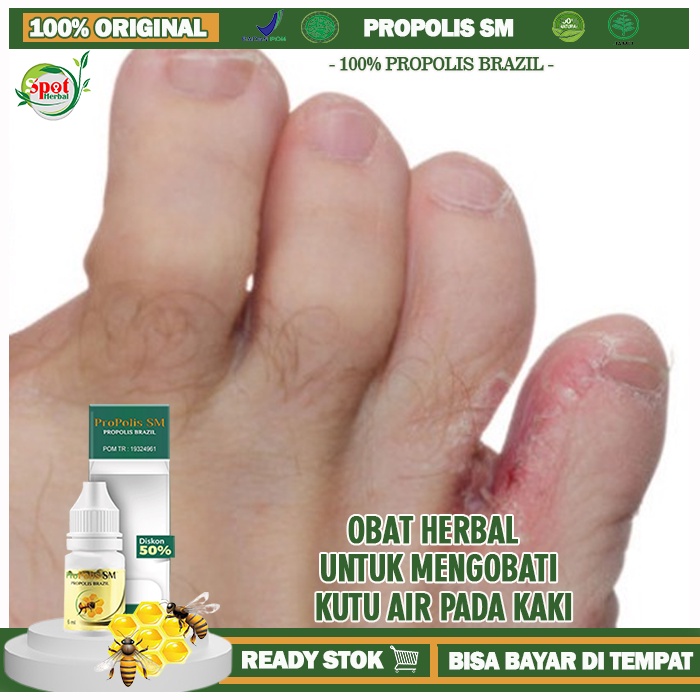 Jual Obat Kutu Air Pada Kaki Obat Penghilang Kutu Air Di Kaki Dan Tangan Obat Gatal Di Sela 2428