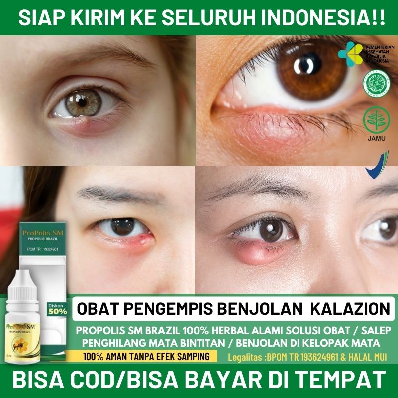 Jual Obat Oles Bintitan Obat Mata Bintitan Untuk Anak Dan Dewasa, Obat ...