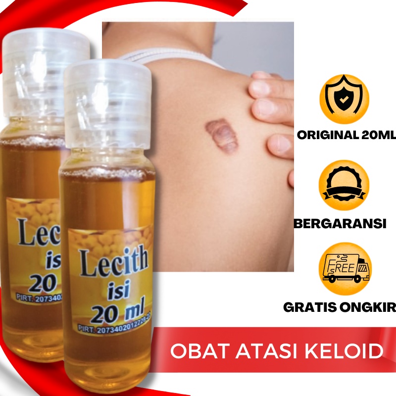 Jual Minyak Obat Penghilang Keloid Yang Sudah Lama Luka Bakar Bagus Scar Krim Keloid Salep Serum