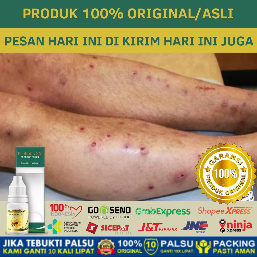 Jual Obat Kulit Koreng Korengan Penyembuh Luka Gatal Luka Borok Bernanah Scabies Budug