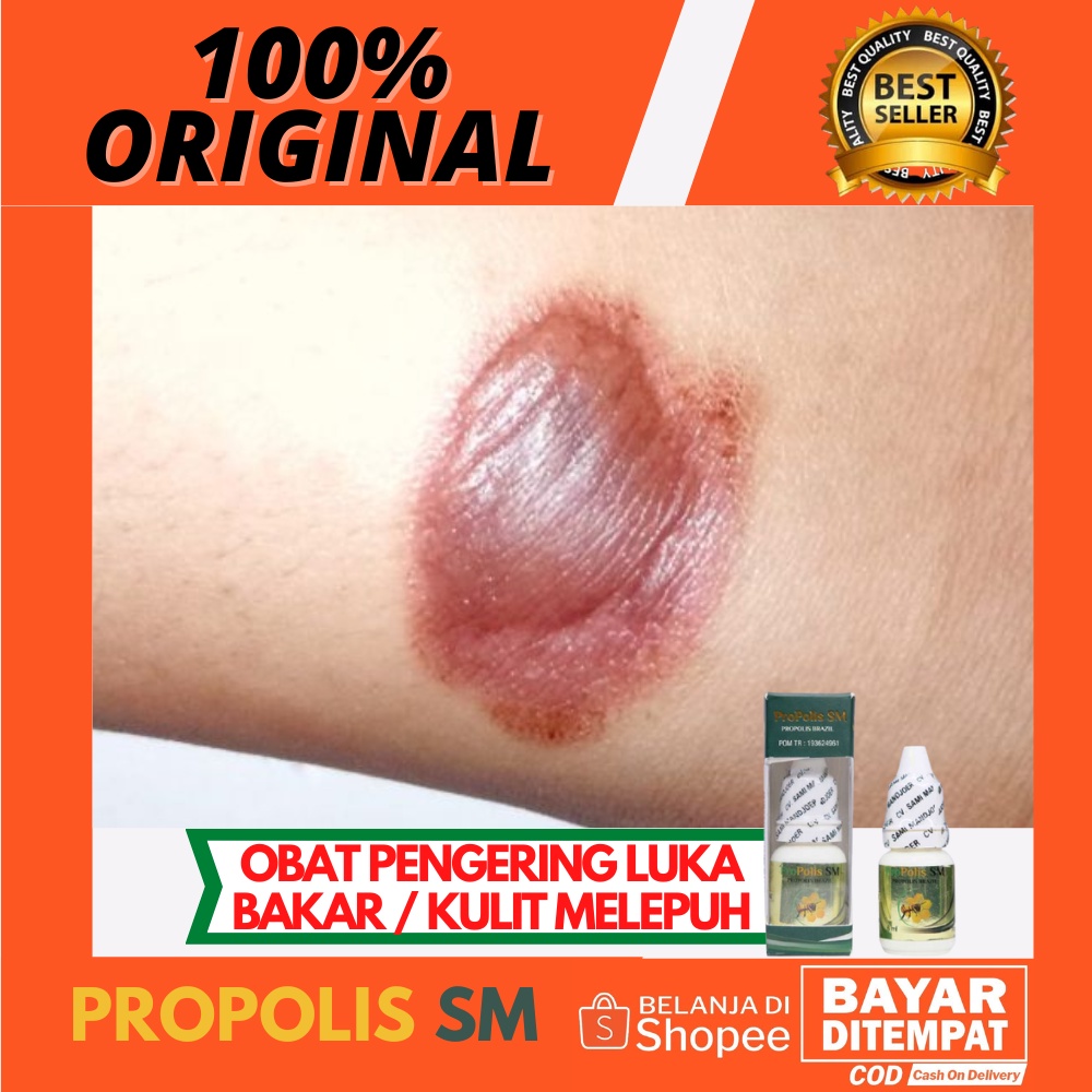 Jual Obat Pengering Luka Knalpot Luka Bakar Melepuh Berair Luka