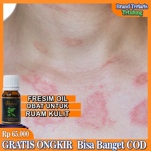 Jual Fresim Oil Tetulung Binahong, Obat Khusus Untuk Ruam Kulit, Obat ...