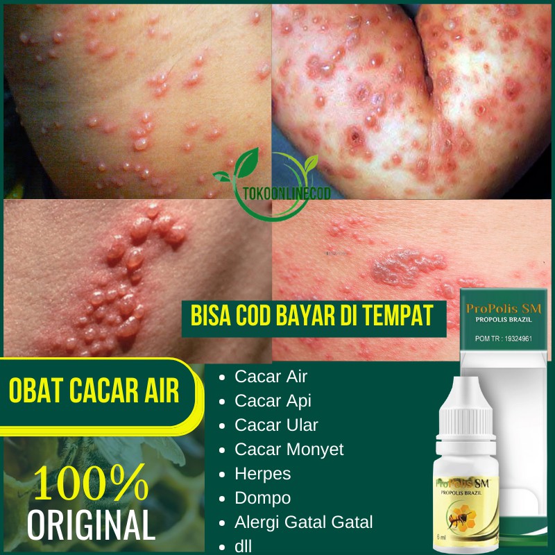 Jual Obat Cacar Air - Cacar Api - Cacar Ular - Herpes - Dompo ...