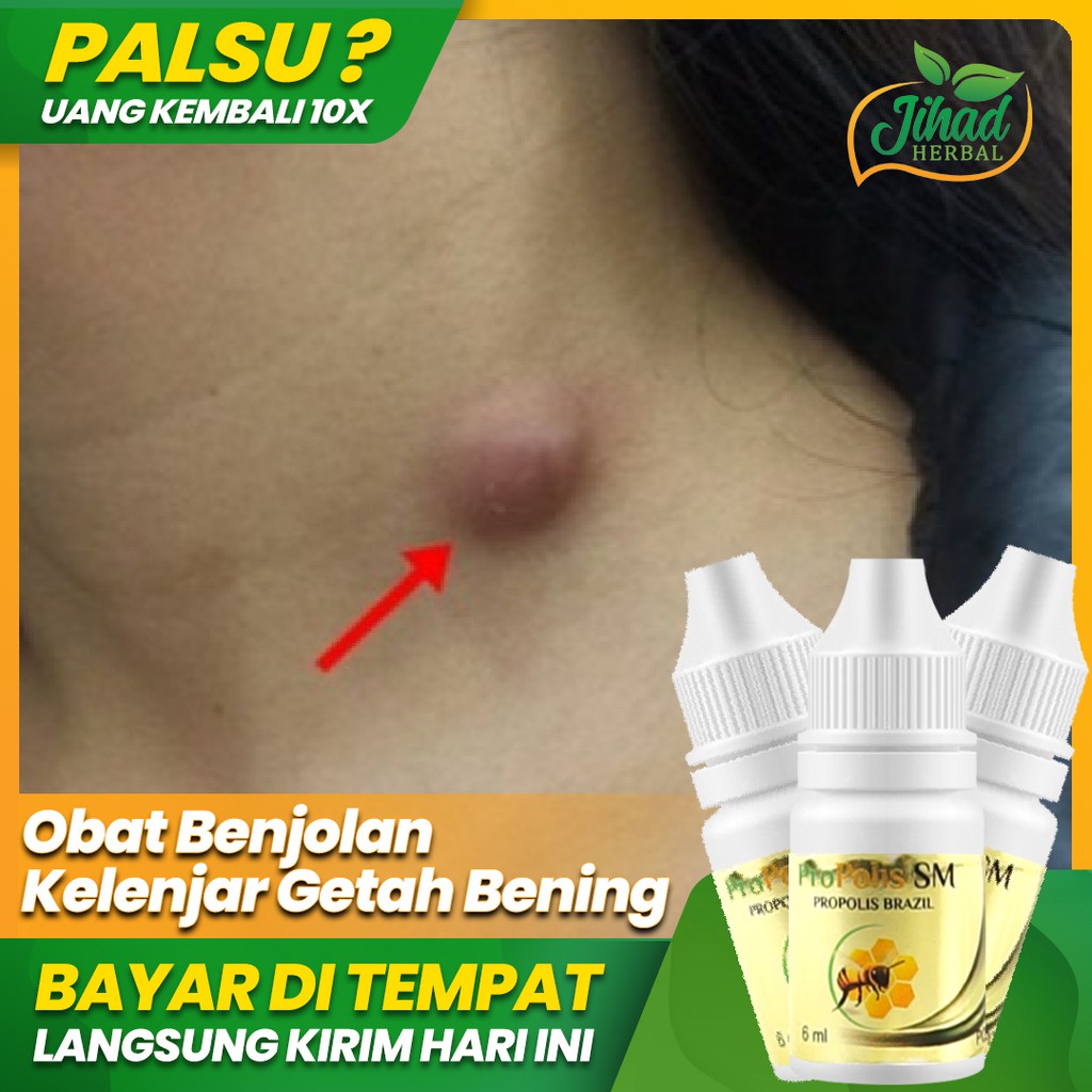 Jual Obat Benjolan Kelenjar Getah Bening Di Leher, LIPOMA, Gondok ...