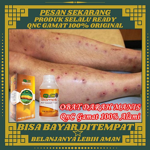 Jual Obat Darah Manis Herbal 100 Alami Obat Amis Daging Penyakit