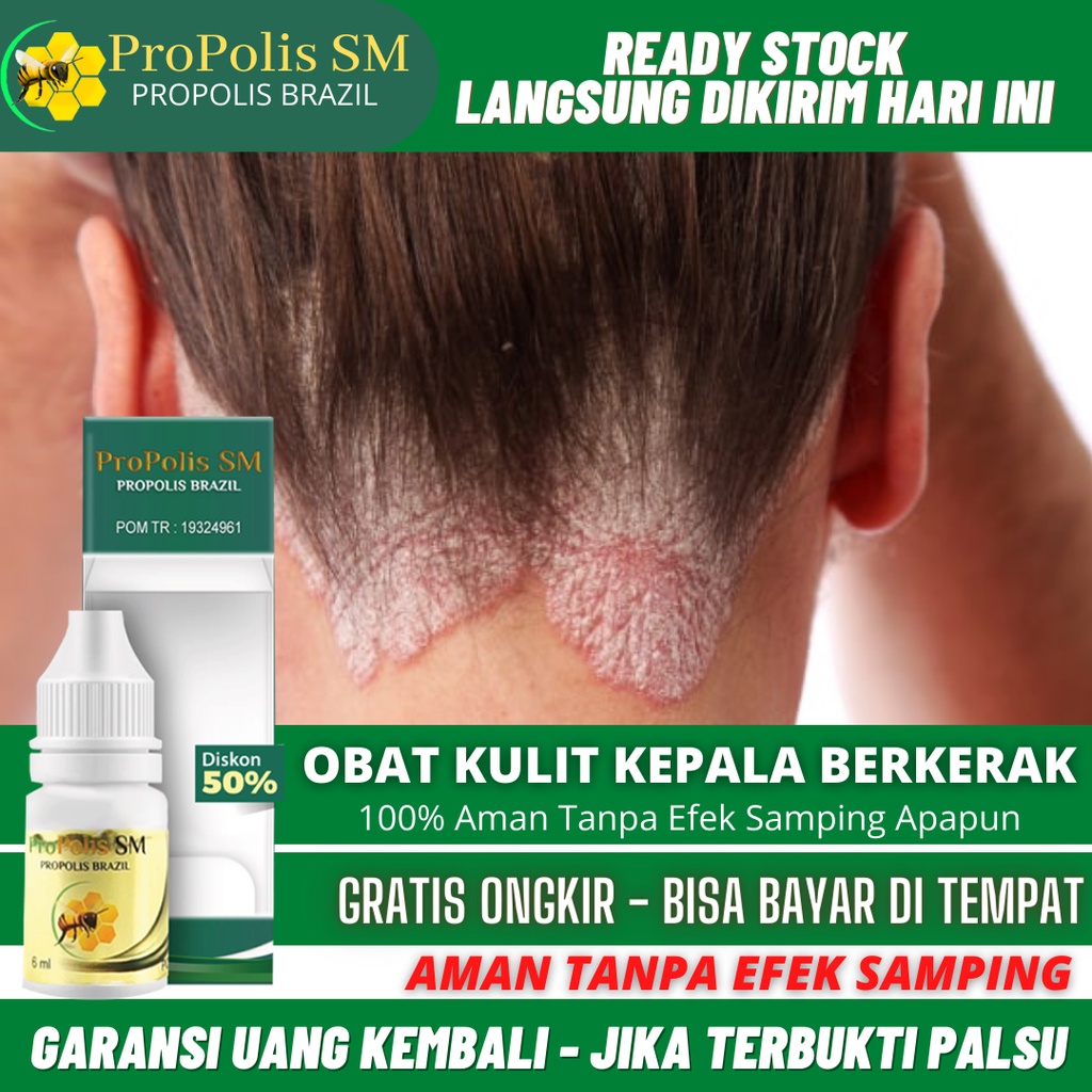 Jual Obat Kulit Kepala Kering Dan Gatal Korengan Infeksi Jamur Di Kulit Kepala Borokan 8509