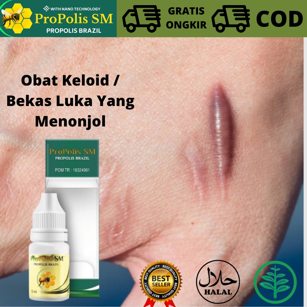 Jual Obat Keloid, Obat Herbal Untuk Menghilangkan Keloid/Benjolan, Obat
