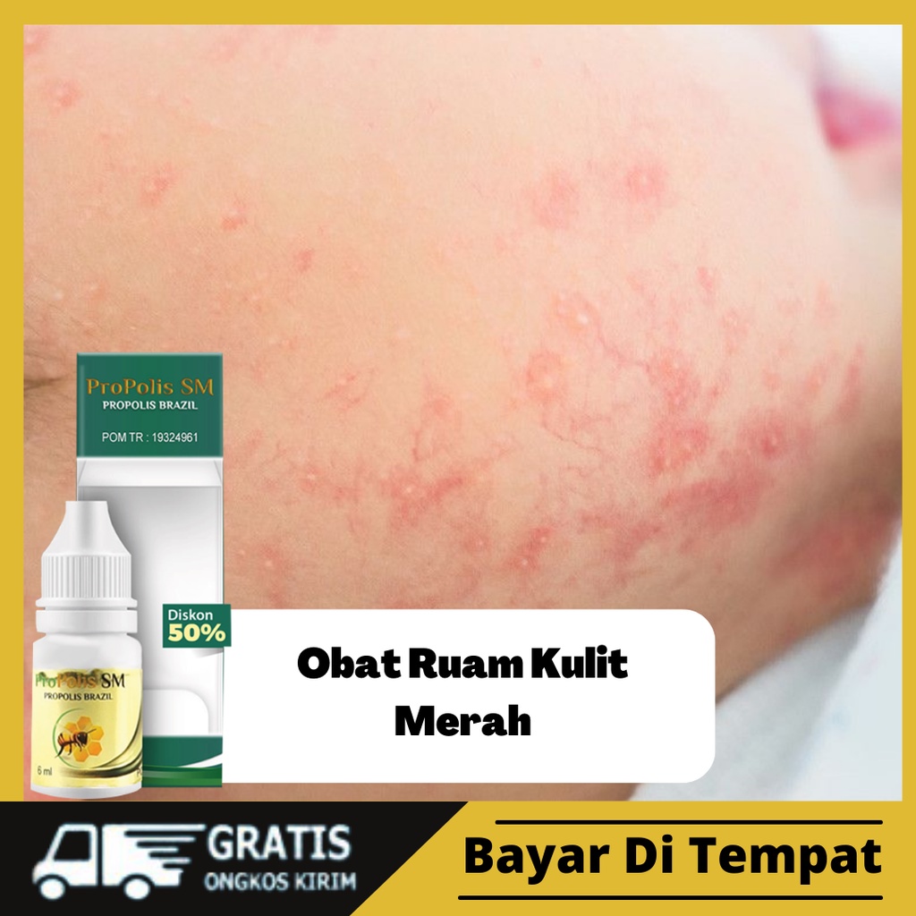 Jual Obat Ruam Kulit Merah , Gatal Gatal Bercak Merah , Eksim Basah Dan ...