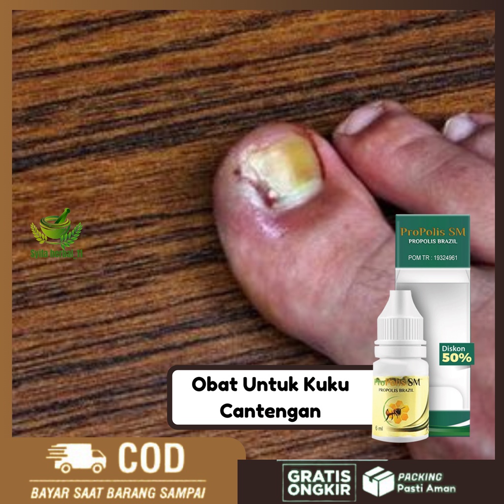 Jual Obat Untuk Kuku Cantengan Centengan Kuku Tangan Kuku Kaki