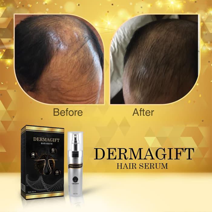 Jual Dermagift Hair Serum - Dijamin Tumbuh !!! | Shopee Indonesia