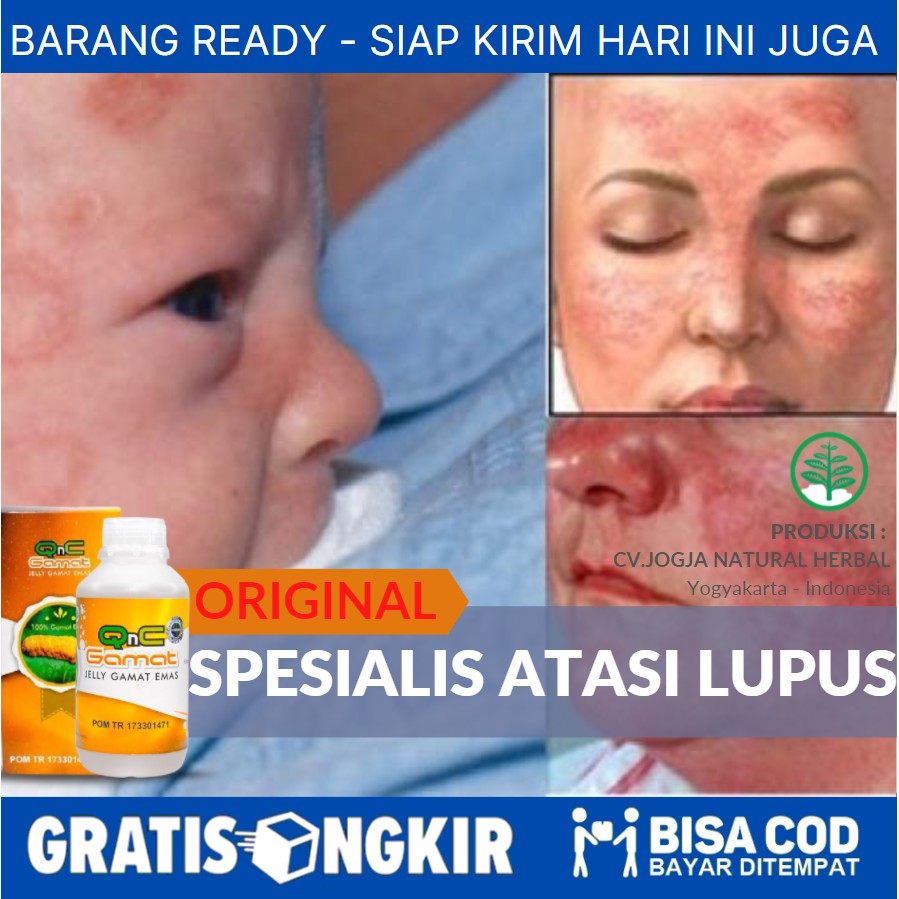 Jual Obat Herbal Untuk Penyakit Lupus, Radang Pada Kulit, Autoimun