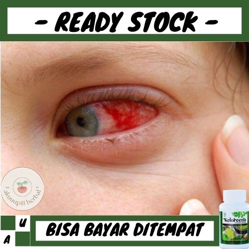 Jual Obat Mata Merah, Obat Untuk Mata Merah, Obat Infeksi Mata, Obat ...