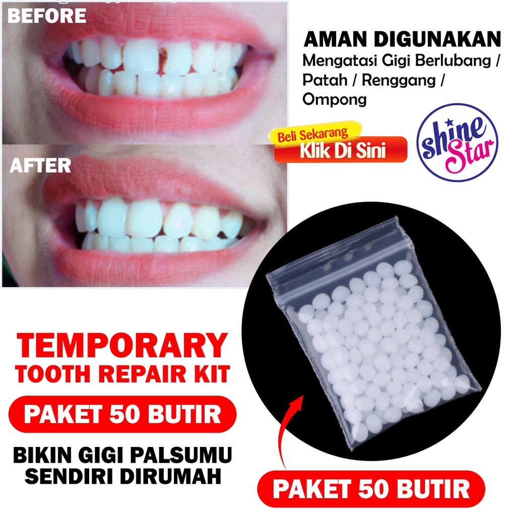 Jual 1000 BUTIR Temptooth Temp Tooth Lem Gigi Palsu Bahan Tambal Temporary  - 200 Butir - Jakarta Barat - Behell Dental
