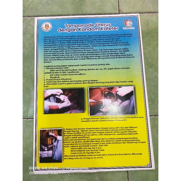 Jual (24) POSTER TAMPONADE UTERUS DGN KONDOM KATETER | Shopee Indonesia