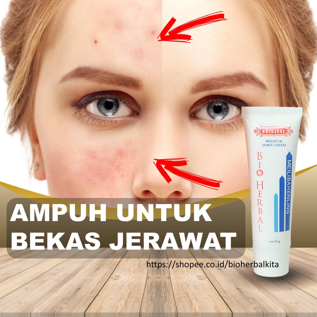 Jual Penghilang Bekas Jerawat Obat Salep Cream Krim Penghilang ...