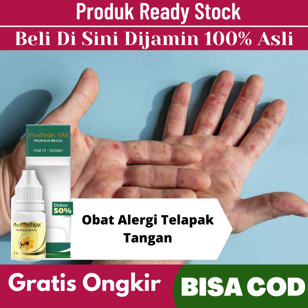 Jual Obat Alergi Telapak Tangan Bentol Berair Di Telapak Tangan Bintik Berair Di Telapak 9599