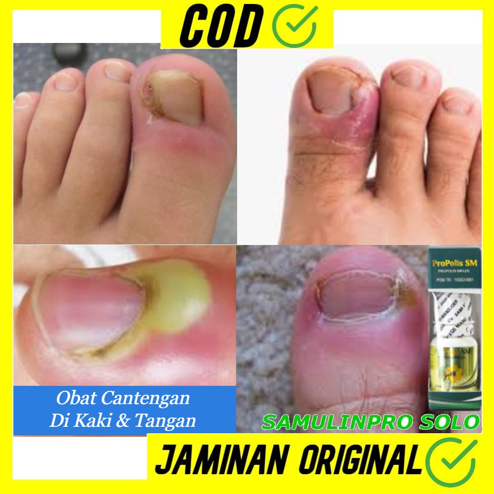 Jual Obat Cantengan Jamur Kuku Cantengan Di Kaki Tangan Cenang Bisul