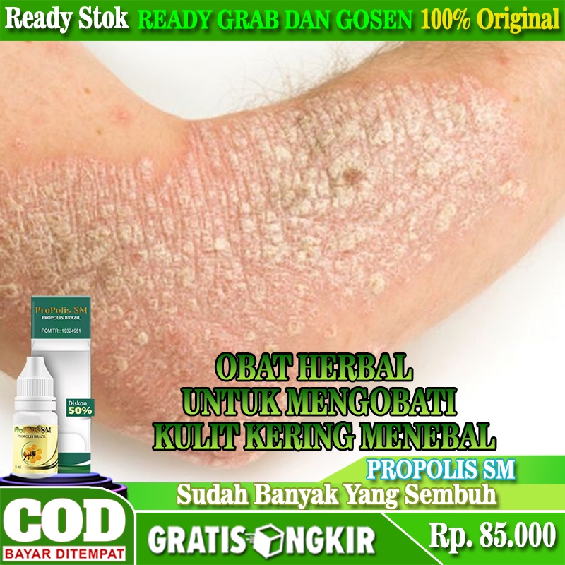 Jual Obat Oles Kulit Kering Menebal, Oles Jamur Kulit Gatal Kering ...