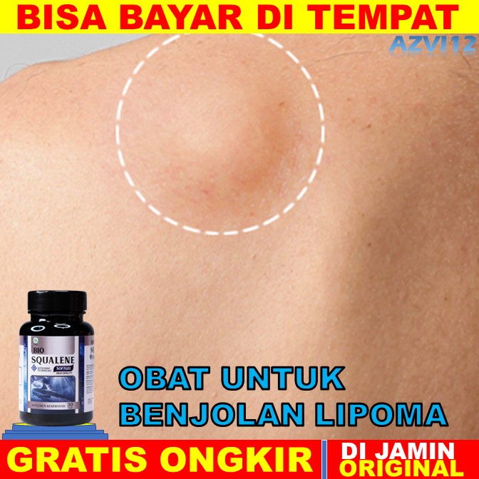 Jual Obat Benjolan Lipoma Obat Benjolan Lipoma, Obat Penghancur ...