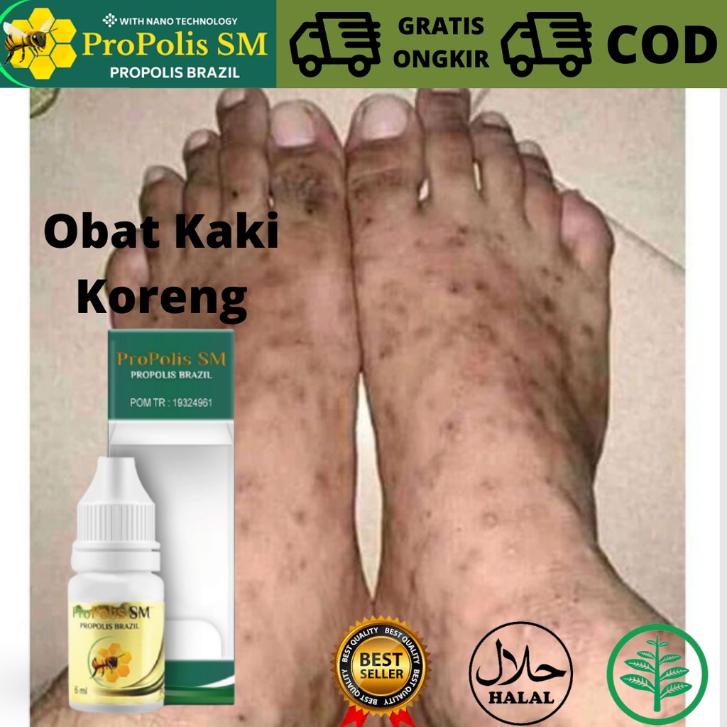 Jual Obat Penghilang Bekas Koreng Obat Koreng Penghilang Koreng Di