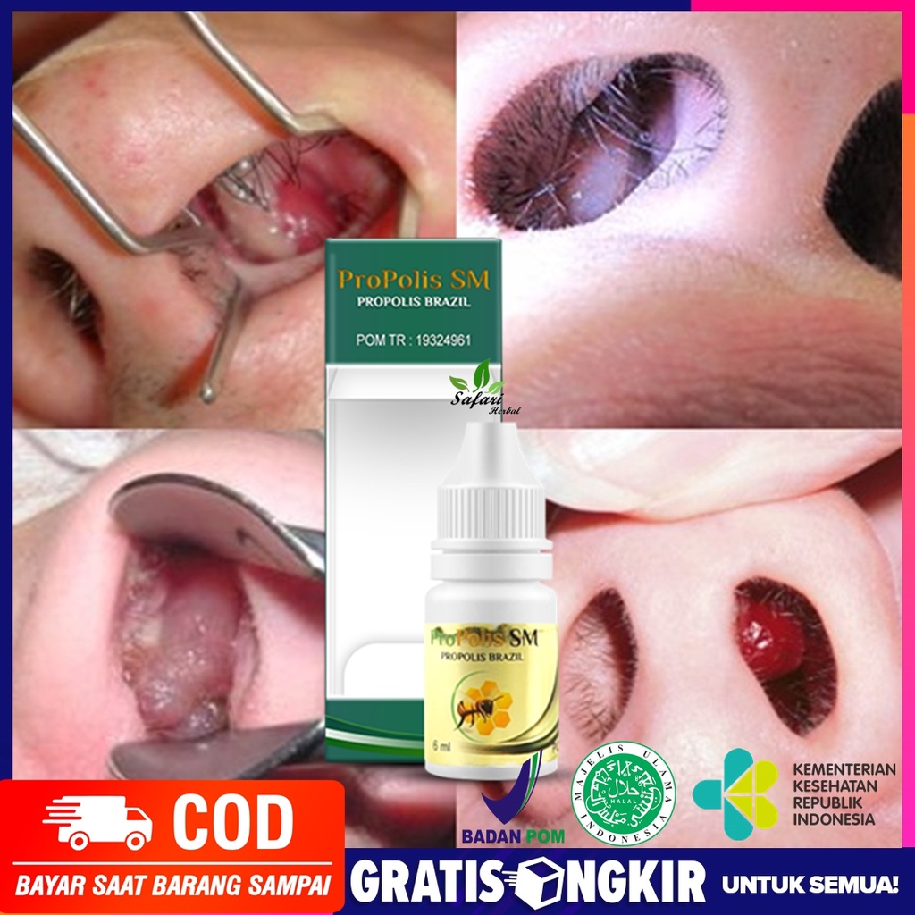 Jual Obat Tetes Penghilang Benjolan Di Dalam Hidung Obat Polip Hidung Obat Perontok Daging