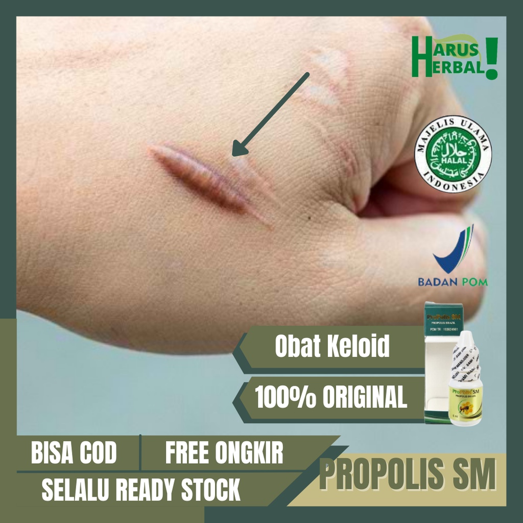 Jual Obat Penghilang Keloid, Daging Jadi, Benjolan Bekas Luka, Obat