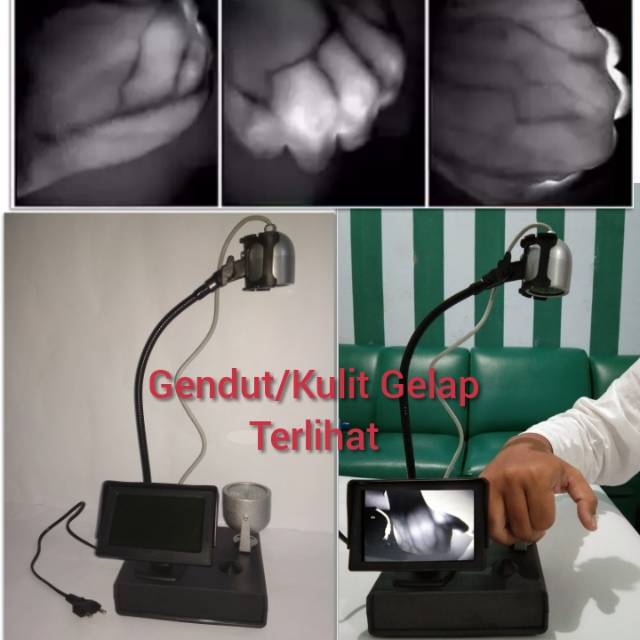 Jual Alat Pencari Vena Saat Pasang Infus Gendut Kulit Gelap Bisa Vein