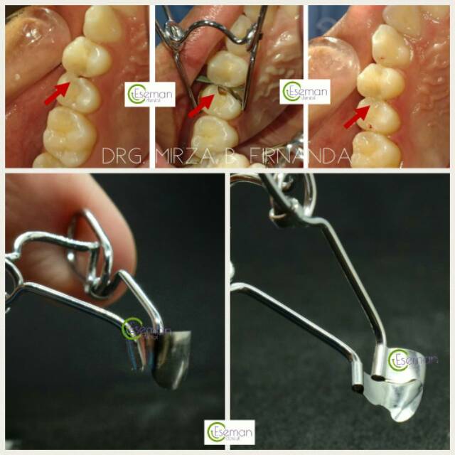 Jual Dental Matrix Springclip Sectional Saddle Seluloid Matriks Strip ...