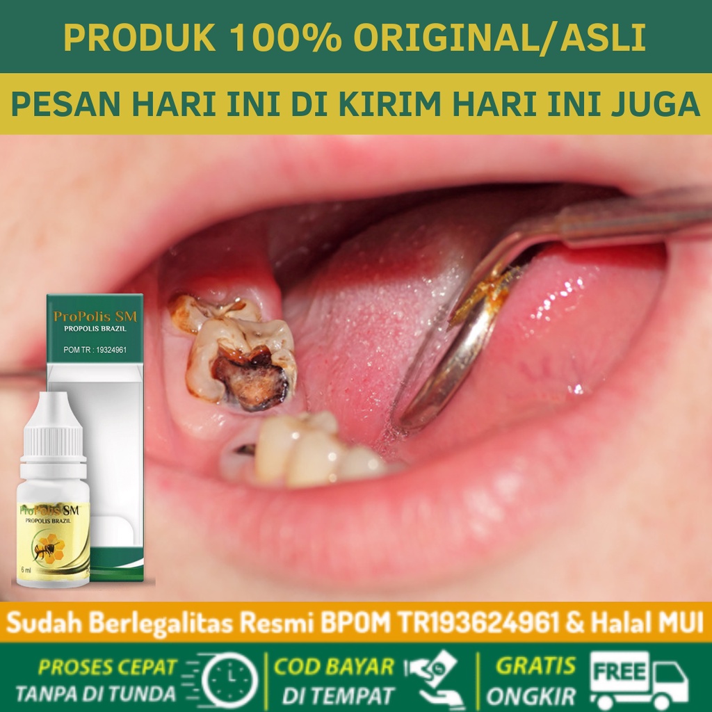 Jual Obat Gigi Berlubang Nyeri Linu, Gusi Bengkak, Sakit Gigi Nyut ...