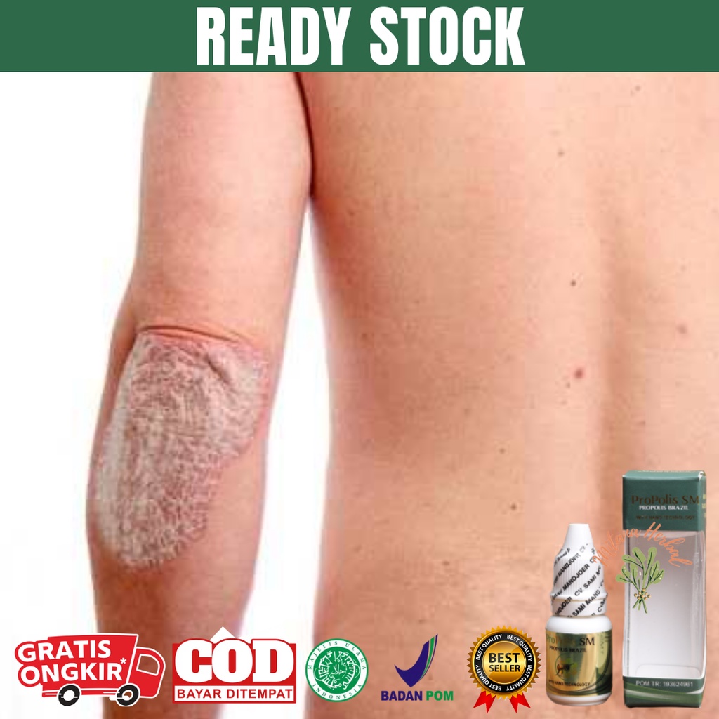 Jual Obat Dermatitis Seboroik Obat Dermatitis Atopik Obat Dermatitis Kontak Obat Dermatitis 