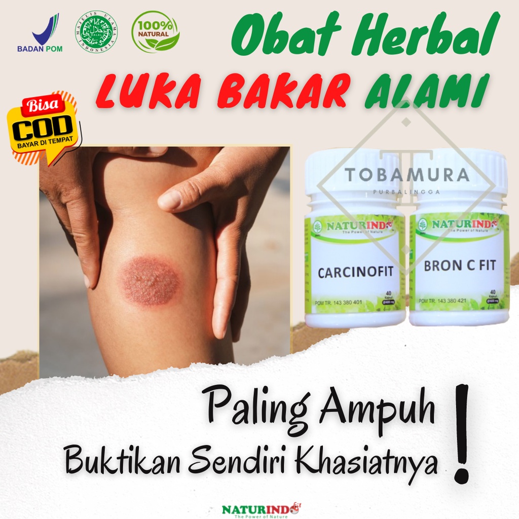 Jual Obat Luka Bakar Melepuh Kena Kenalpot Air Panas Di Kaki Wajah