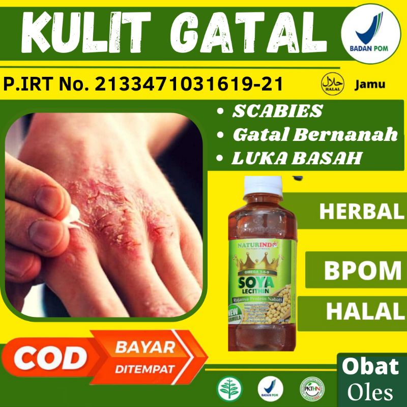 Jual Obat Oles Kulit Jari Tangan Kering Pecah Pecah Bersisik Menebal Mengelupas Gatal Berair 9830