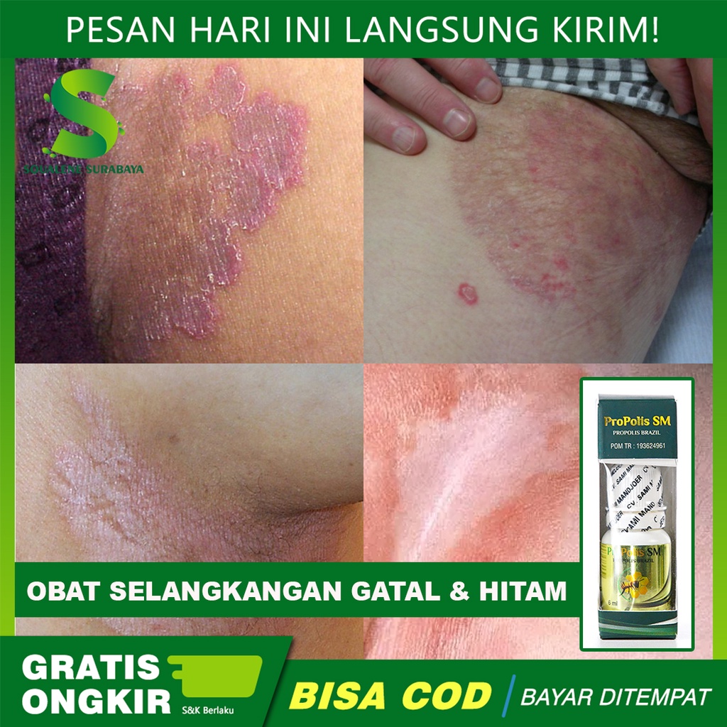 Jual Obat Selangkangan Gatal dan Hitam Selangkangan Lecet Infeksi