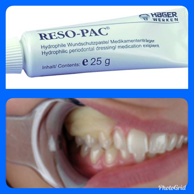 Jual RESOPAC Periodontal Pack | Shopee Indonesia