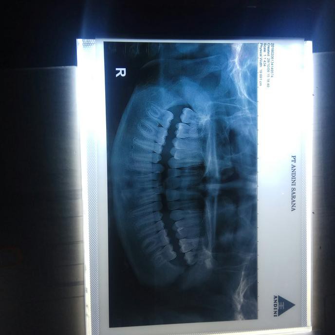 Jual Dental viewer X ray LED rontgen portable A4 slim | Shopee Indonesia