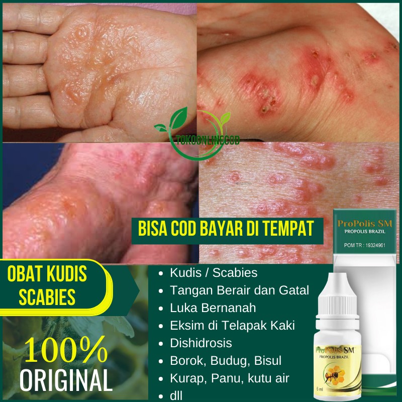 Jual Obat Kudis Scabies Tangan Berair Dan Gatal Luka Bernanah Eksim Di Telapak Kaki 4631