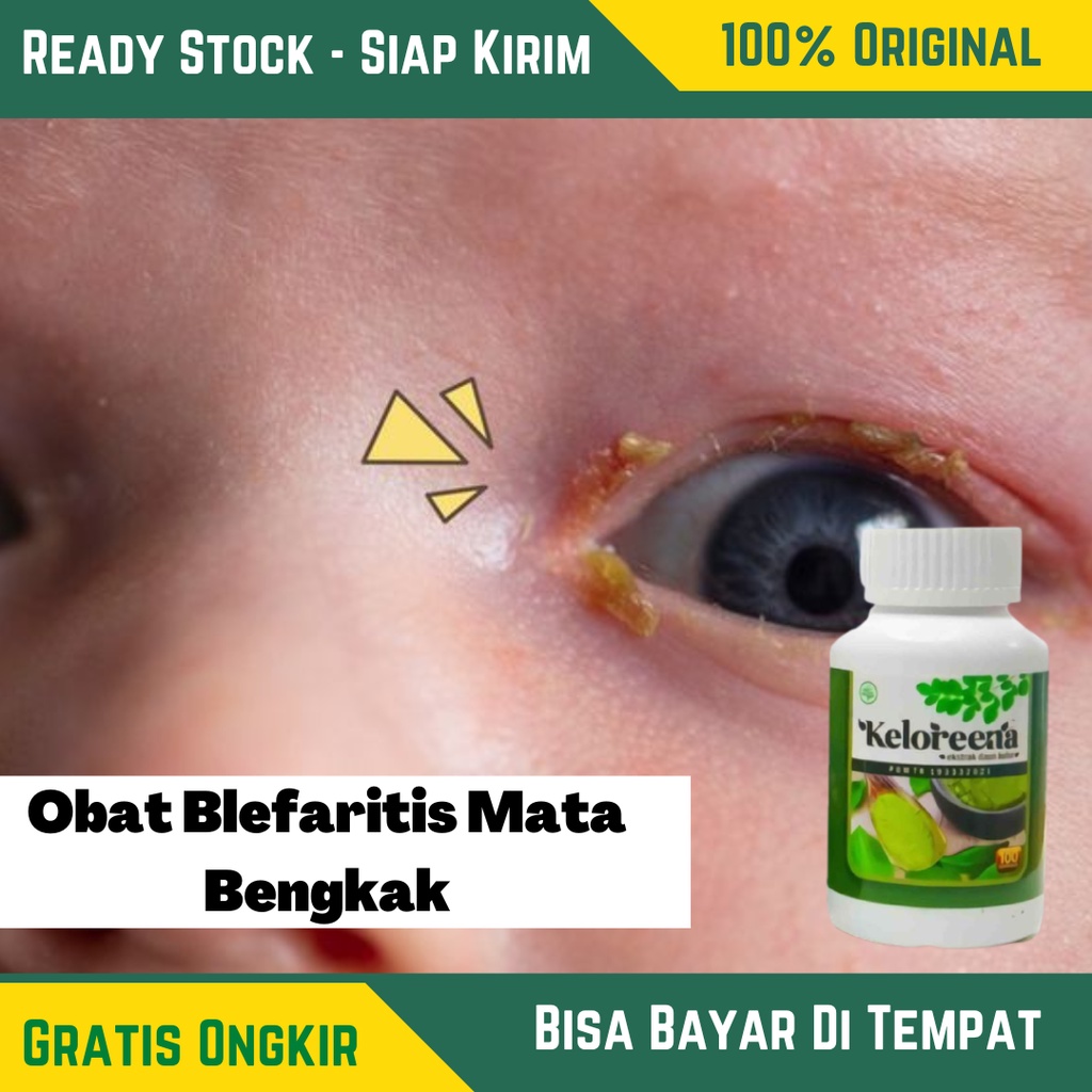 Jual Obat Blefaritis Mata Bengkak , Kelopak Mata Terasa Gatal , Mata