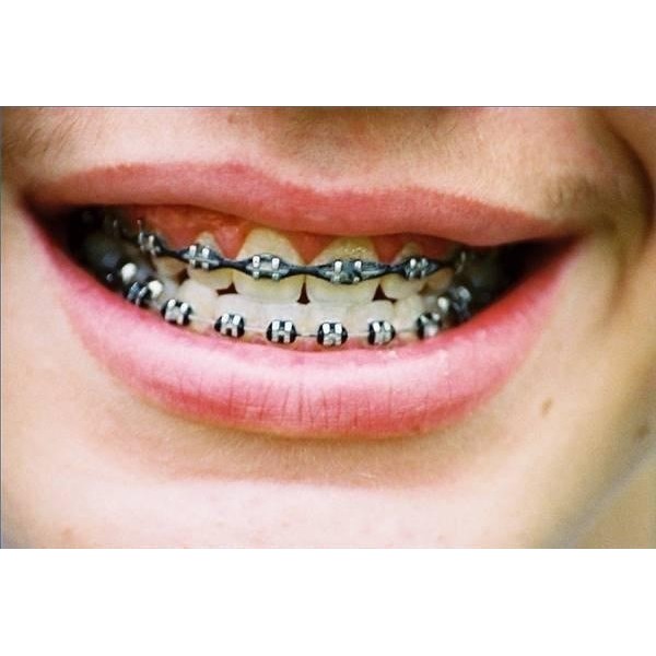 Jual Behel Fashion/Behel Metal/Behel Gigi/Behel Orthodontic/Behel Lepas ...