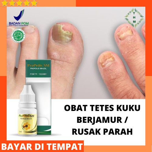 Jual Obat Kuku Berjamur Rusak Parah Cantengan Bengkak Bernanah Bau